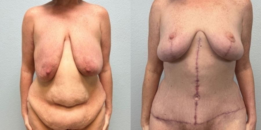 After Weight Loss - Case 19453