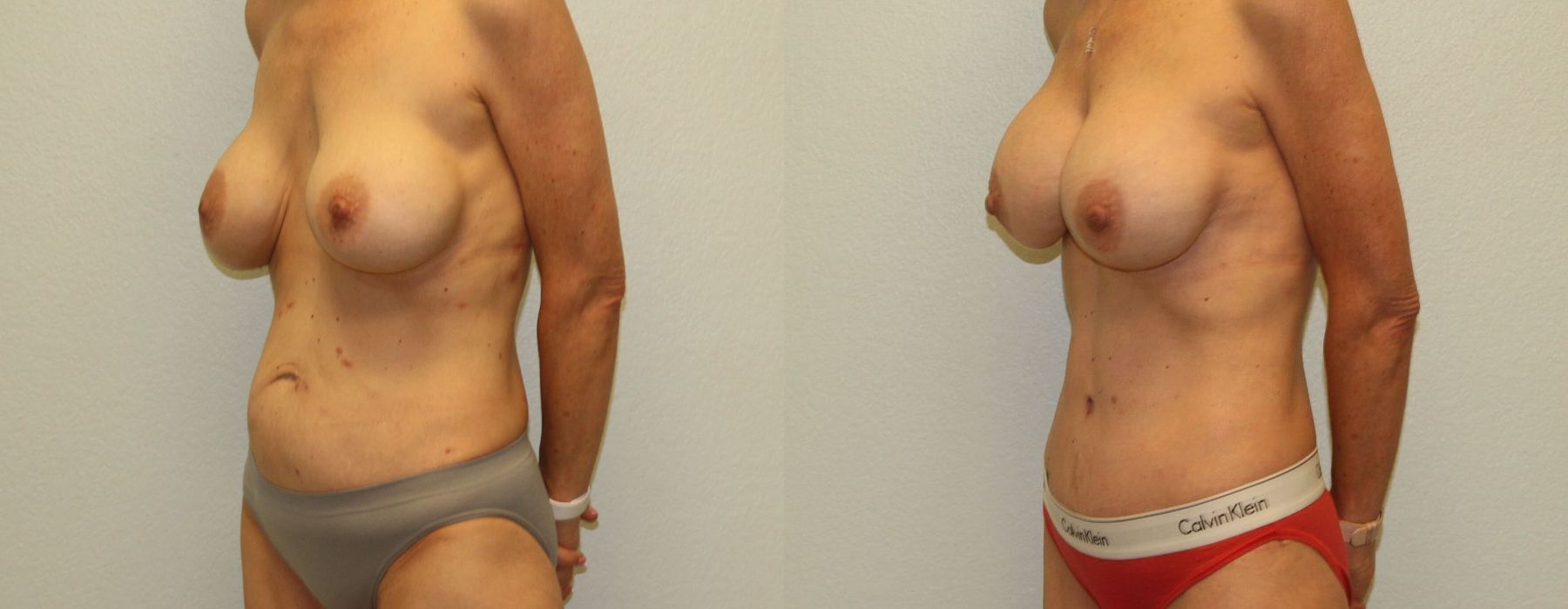 Mommy Makeover - Thumbnail 2