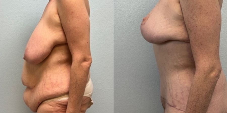 After Weight Loss - Thumbnail 3