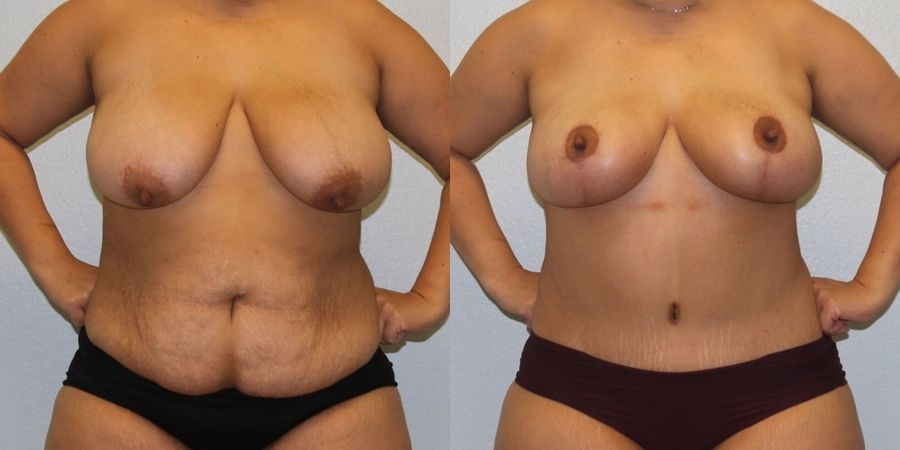 After Weight Loss - Case 19448