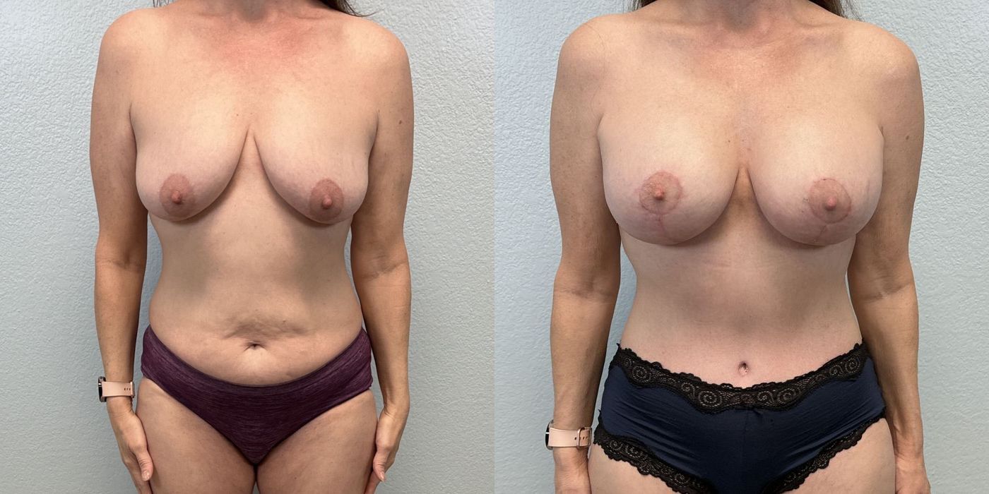 After Weight Loss - Case 19443