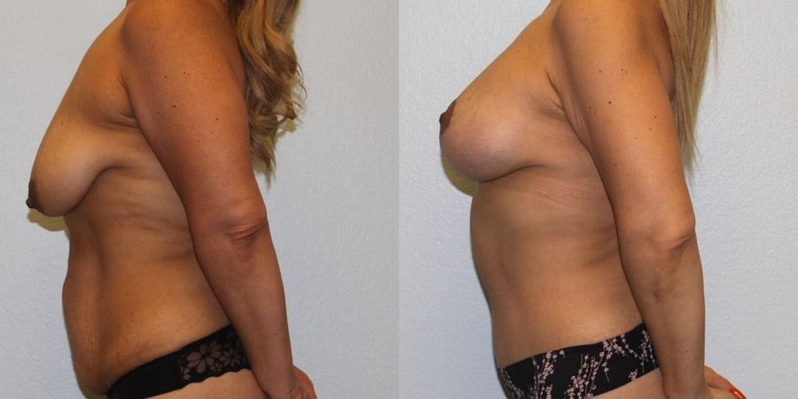 After Weight Loss - Thumbnail 3