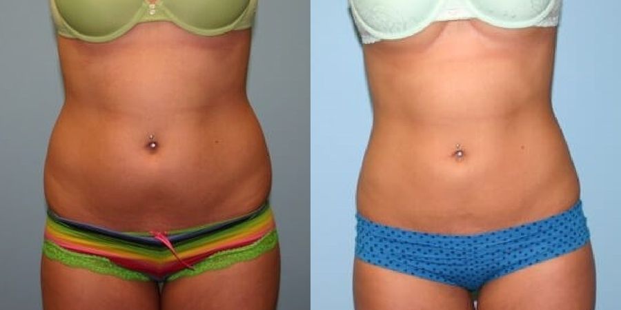 Body Contouring - Case 19461