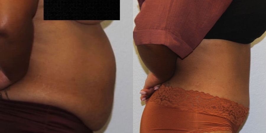 Body Contouring - Thumbnail 3