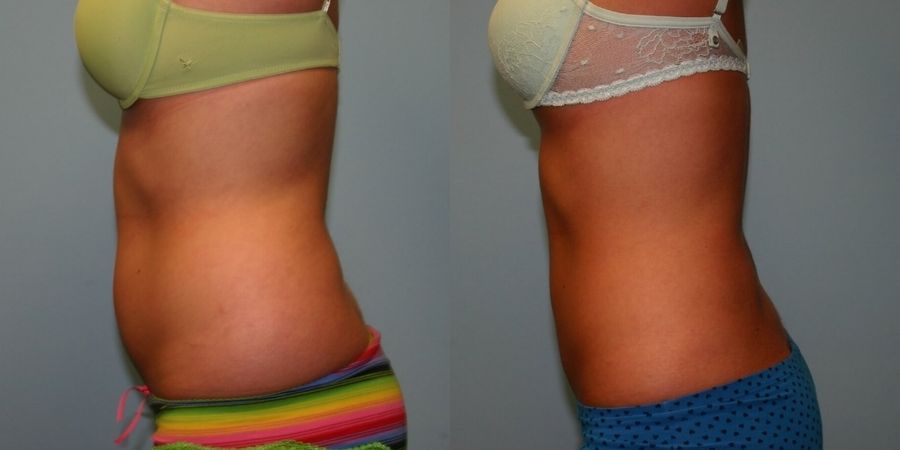 Body Contouring - Thumbnail 2