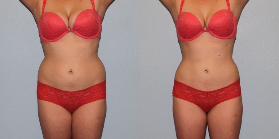 Body Contouring - Case 19125