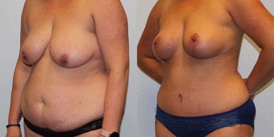 Body Contouring - Thumbnail 2