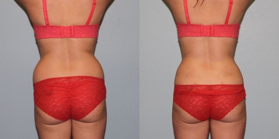 Body Contouring - Thumbnail 3