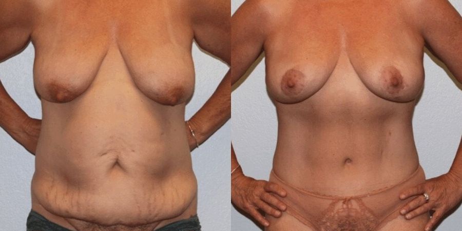 Body Contouring - Case 19456