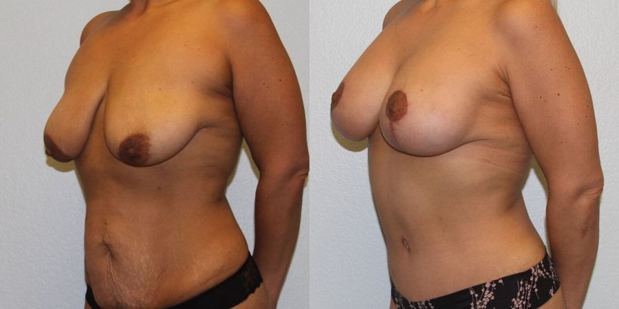 Body Contouring - Thumbnail 2