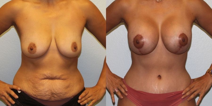 Body Contouring - Case 19454