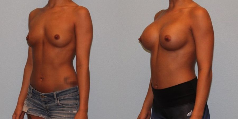 Breast Augmentation - Thumbnail 2
