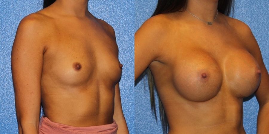 Breast Augmentation - Thumbnail 2