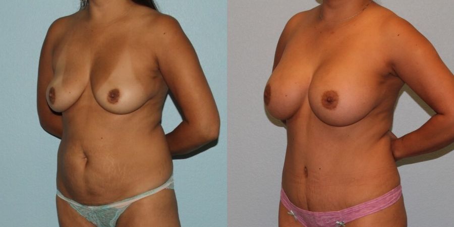 Breast Augmentation - Thumbnail 2