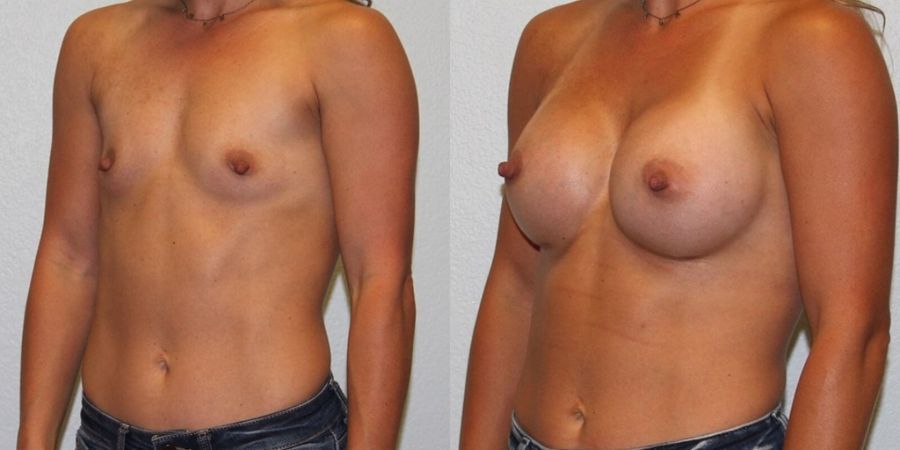 Breast Augmentation - Thumbnail 2
