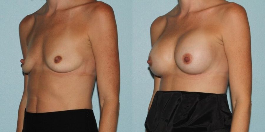 Breast Augmentation - Thumbnail 2
