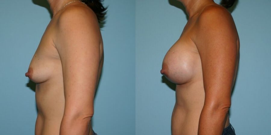 Breast Augmentation - Thumbnail 3