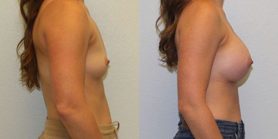 Breast Augmentation - Thumbnail 2