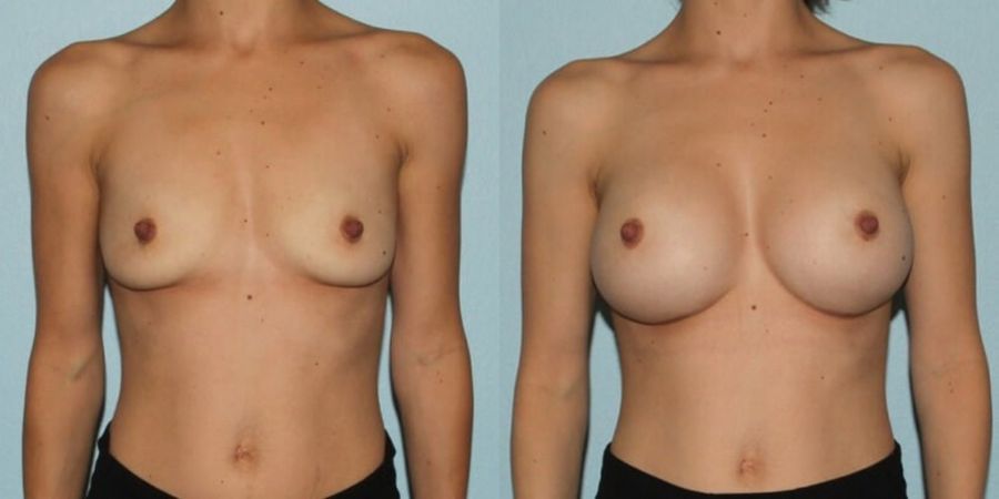 Breast Augmentation - Case 19301