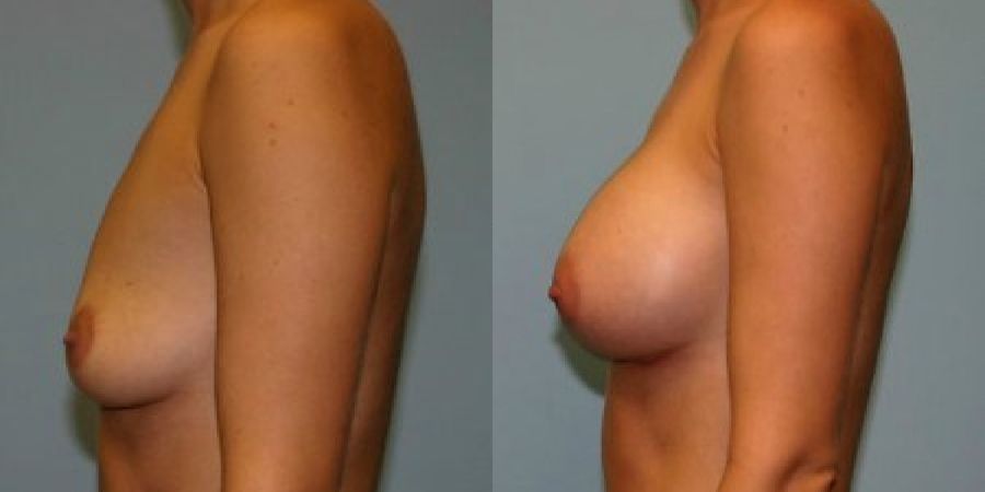 Breast Augmentation - Thumbnail 3