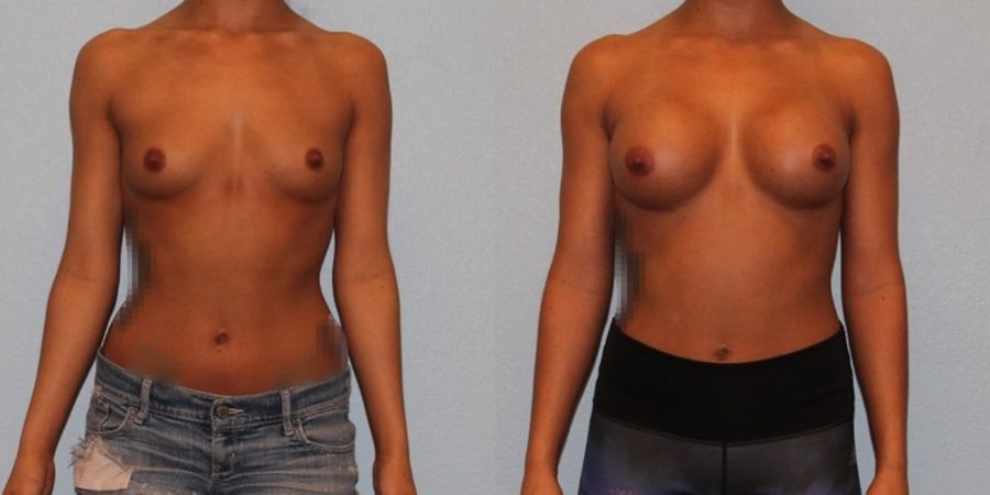 Breast Augmentation - Case 19332