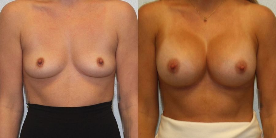 Breast Augmentation - Case 19262