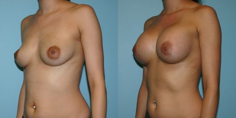 Breast Augmentation - Thumbnail 2
