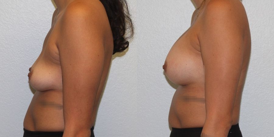 Breast Augmentation - Thumbnail 3
