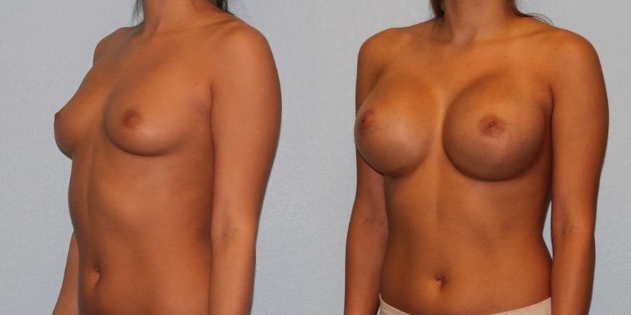 Breast Augmentation - Thumbnail 2
