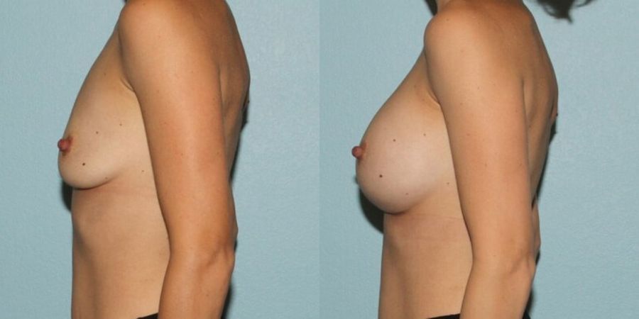 Breast Augmentation - Thumbnail 3
