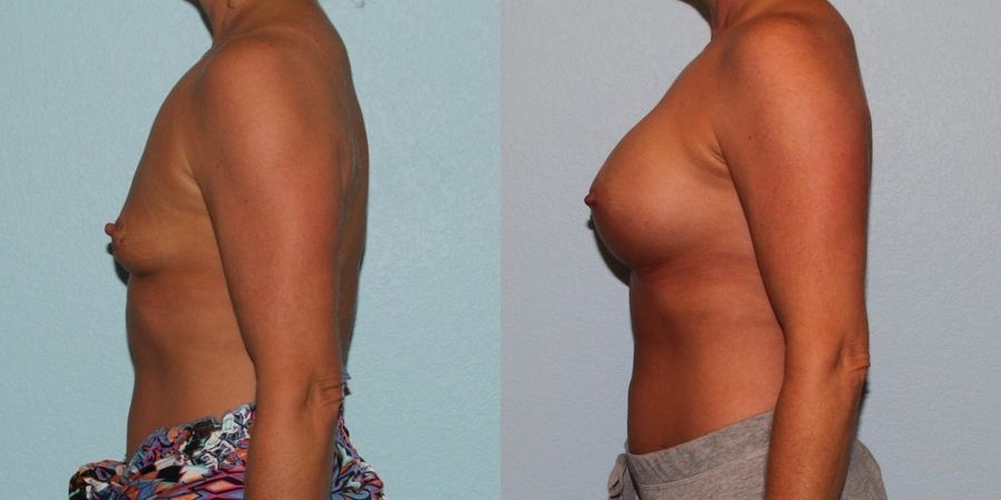 Breast Augmentation - Thumbnail 3