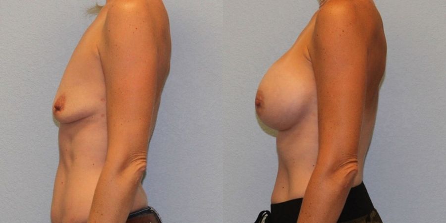 Breast Augmentation - Thumbnail 3