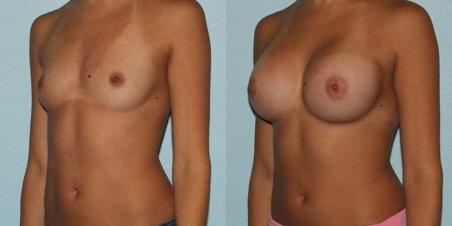 Breast Augmentation - Thumbnail 2