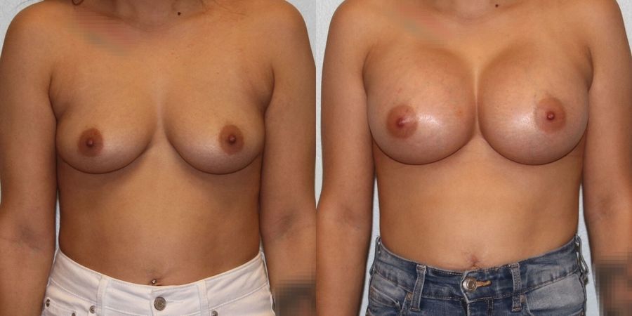 Breast Augmentation - Case 19320