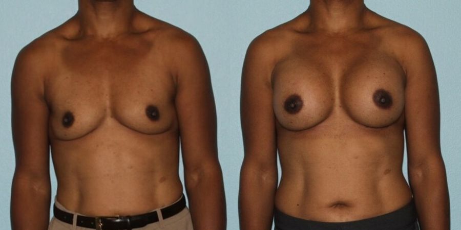 Breast Augmentation - Case 19303