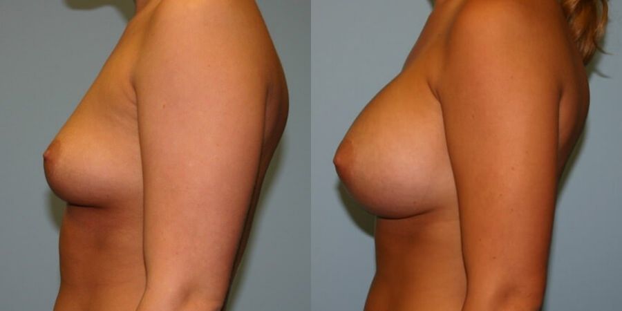 Breast Augmentation - Thumbnail 3
