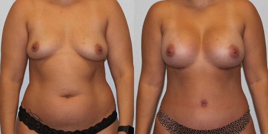 Breast Augmentation - Case 19270