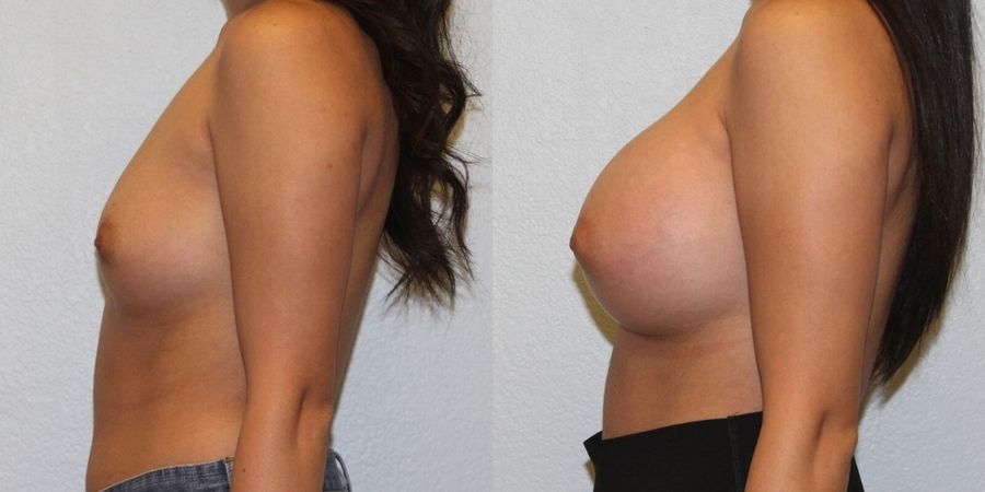 Breast Augmentation - Thumbnail 3