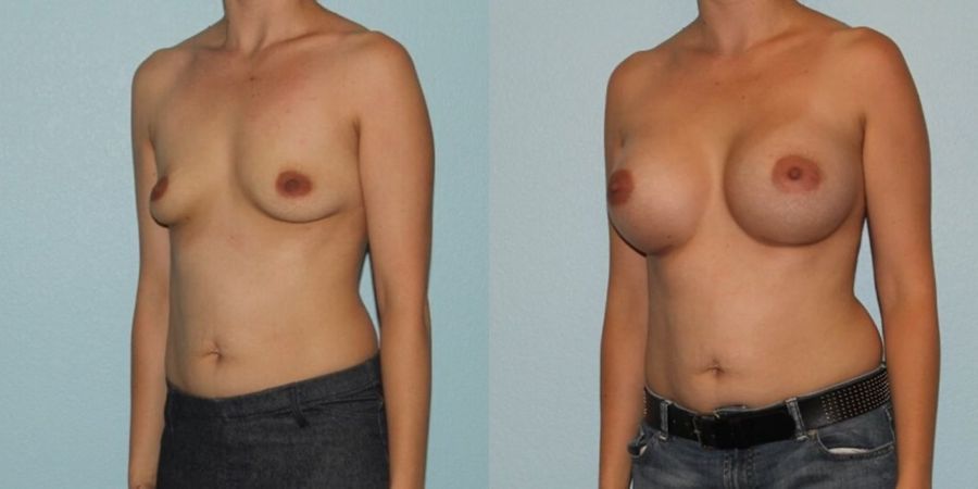 Breast Augmentation - Thumbnail 2