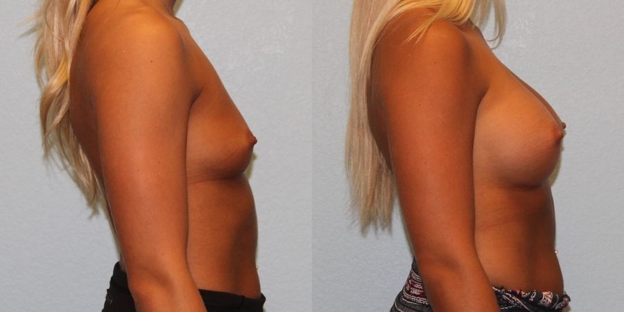 Breast Augmentation - Thumbnail 3