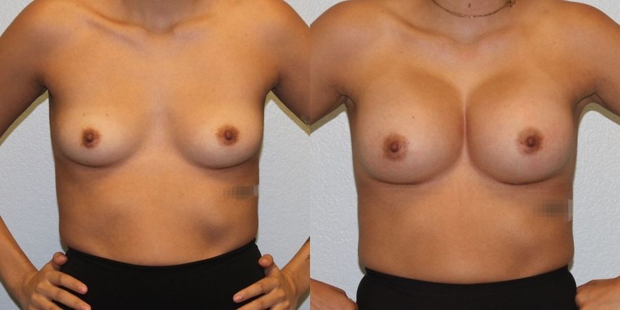 Breast Augmentation - Case 19322