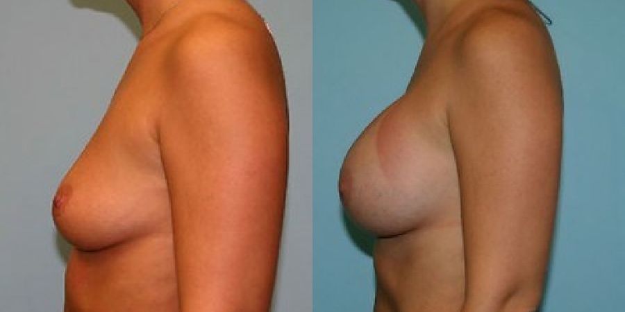 Breast Augmentation - Thumbnail 3