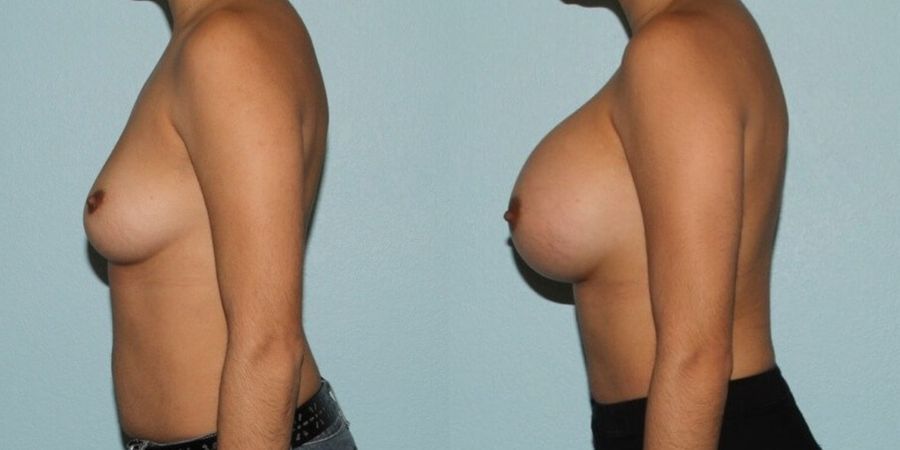 Breast Augmentation - Thumbnail 3
