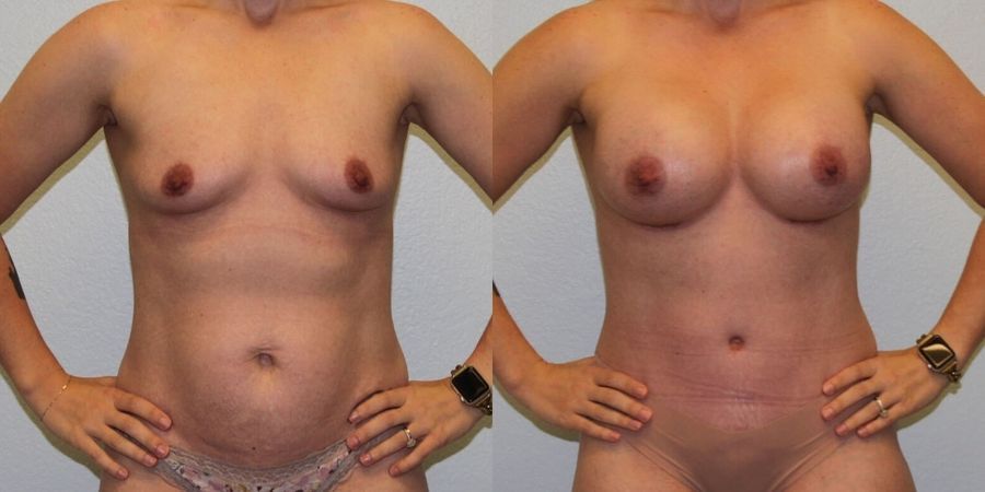 Breast Augmentation - Case 19264