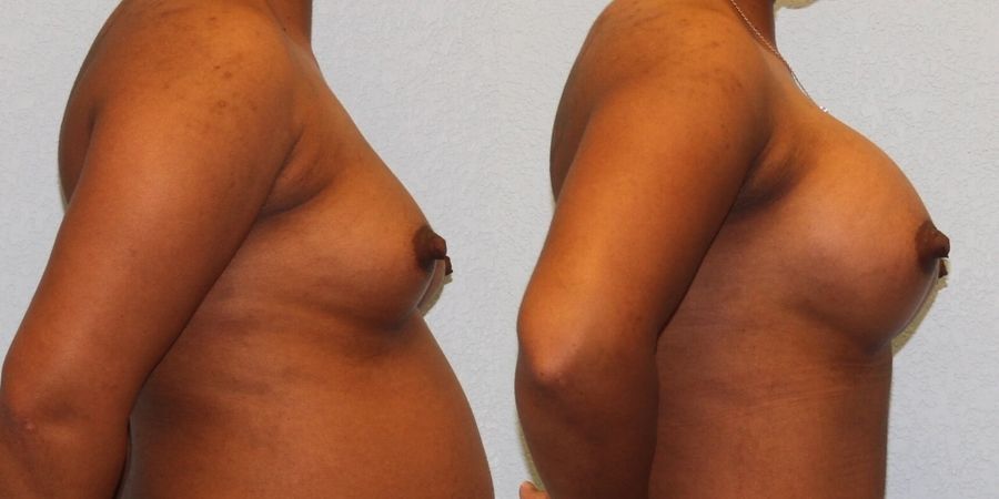 Breast Augmentation - Thumbnail 3