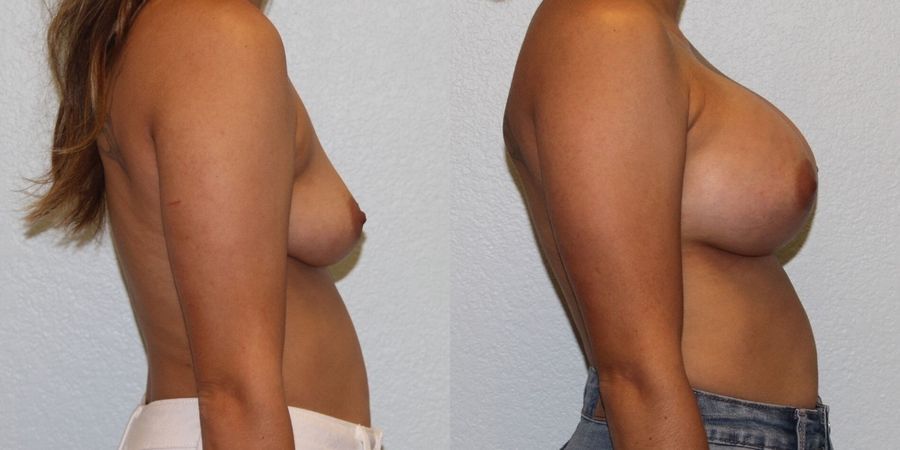 Breast Augmentation - Thumbnail 3