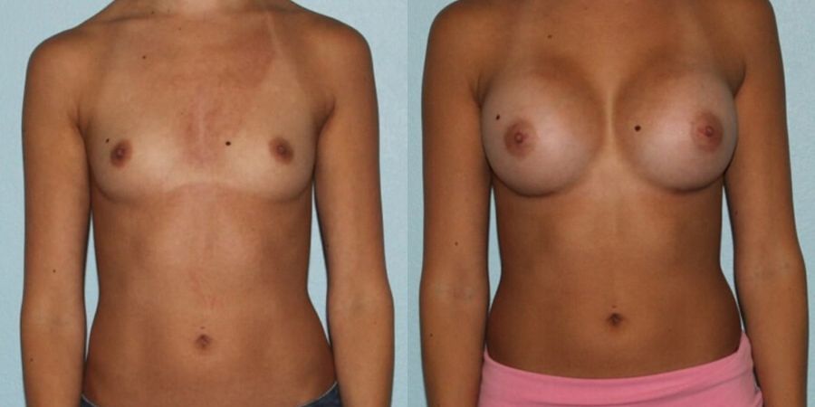 Breast Augmentation - Case 19339