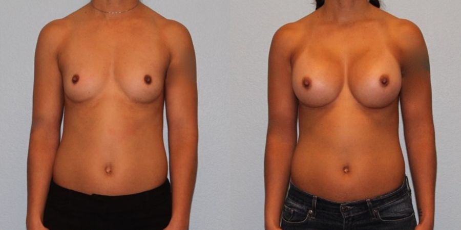 Breast Augmentation - Case 19342