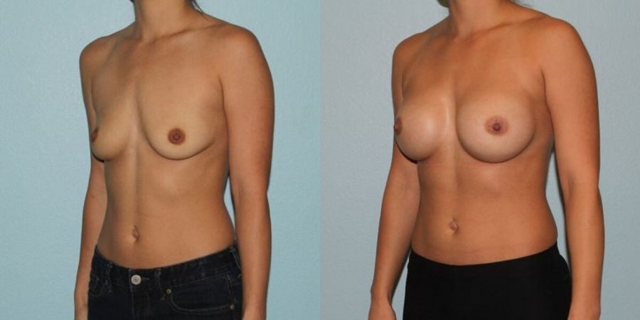 Breast Augmentation - Thumbnail 2