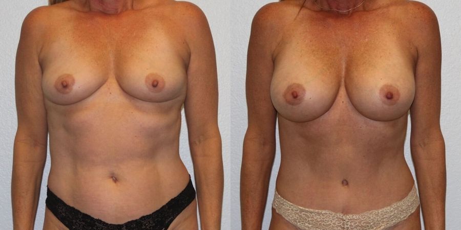 Breast Augmentation - Case 19265